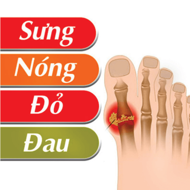 Benh Gout Co Nguy Hiem Khong 