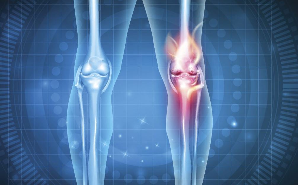 Tràn dịch khớp gối là gì?